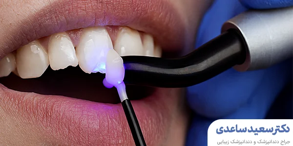 کامپوزیت دندان شکسته