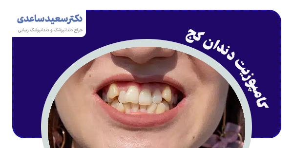 کامپوزیت دندان کج برای چه کسانی است
