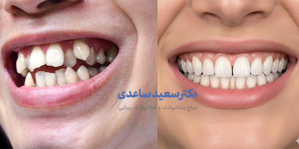 کامپوزیت دندان کج چیست