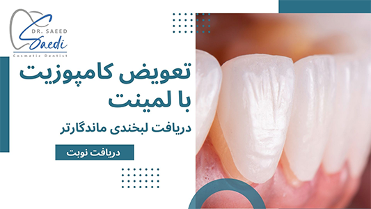 هزیته تعویض کامپوزیت با لمینت چقدر است